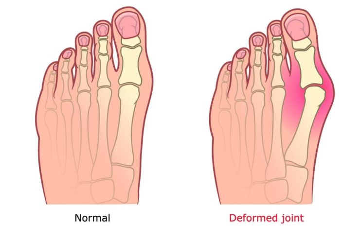 Hallux Valgus