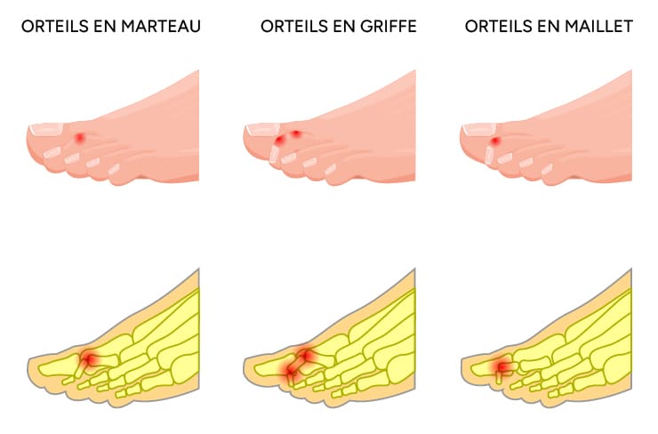 Deformations des orteils en marteau, en griffe, en maillet, NF ortho Bulle Fribourg