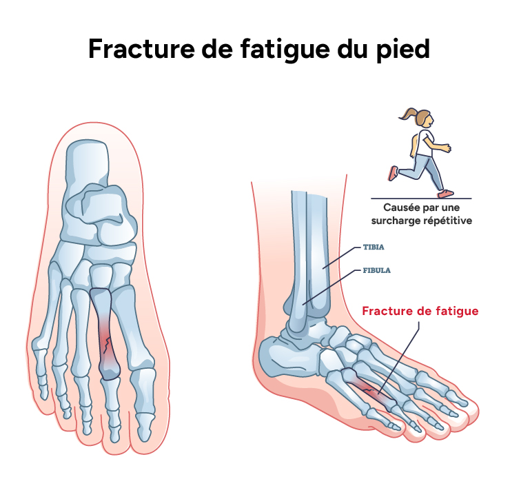 Fracture de fatigue du pied, Nicolas Fragnière Médecin à Bulle