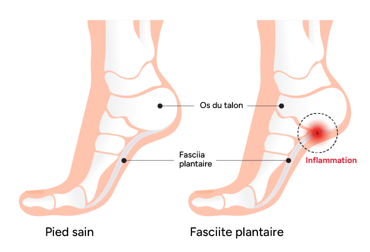 fasciite plantaire, inflammation du pied, Nicolas Fragnière Médecin à Bulle