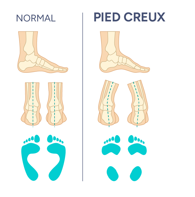 pied creux médecin bulle