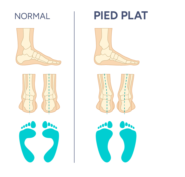 pied plat orthopédie Bulle Nicolas fragnière