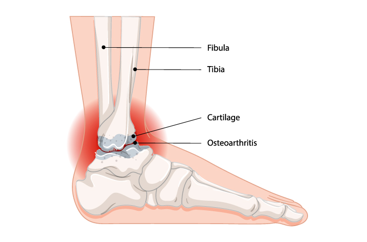 arthrose de la cheville orthopédie Bulle fribourg Nicolas Fragnière