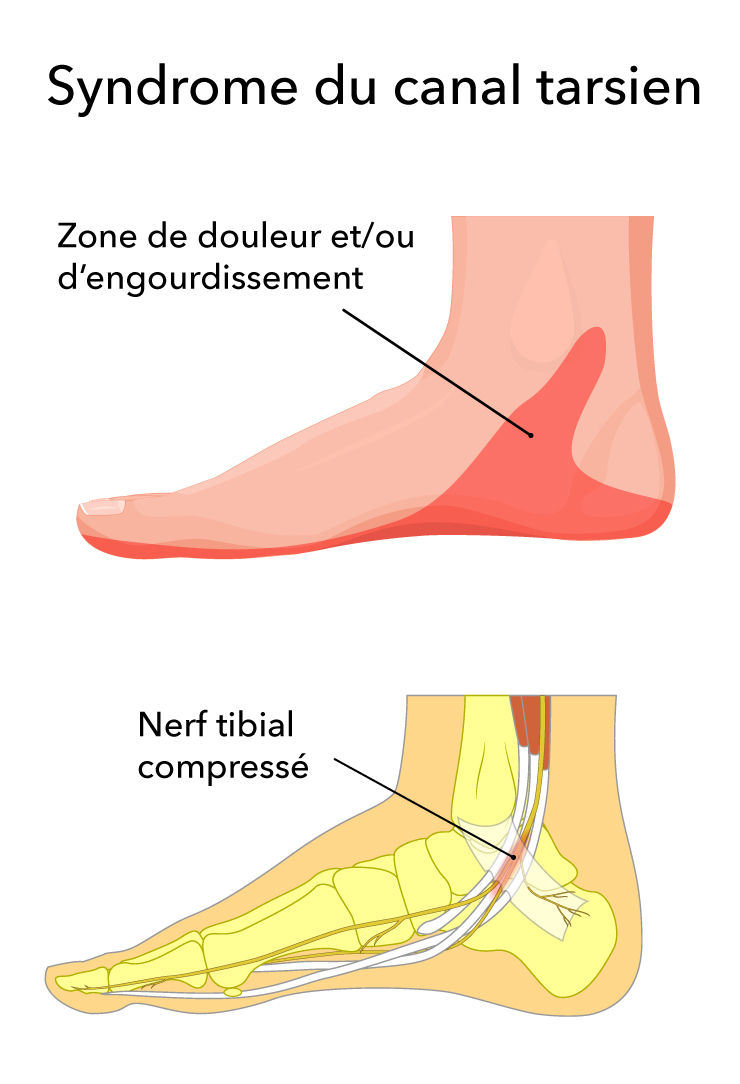 syndrome canal tarsien douleur cheville orthopédie Bulle fribourg Nicolas Fragnière
